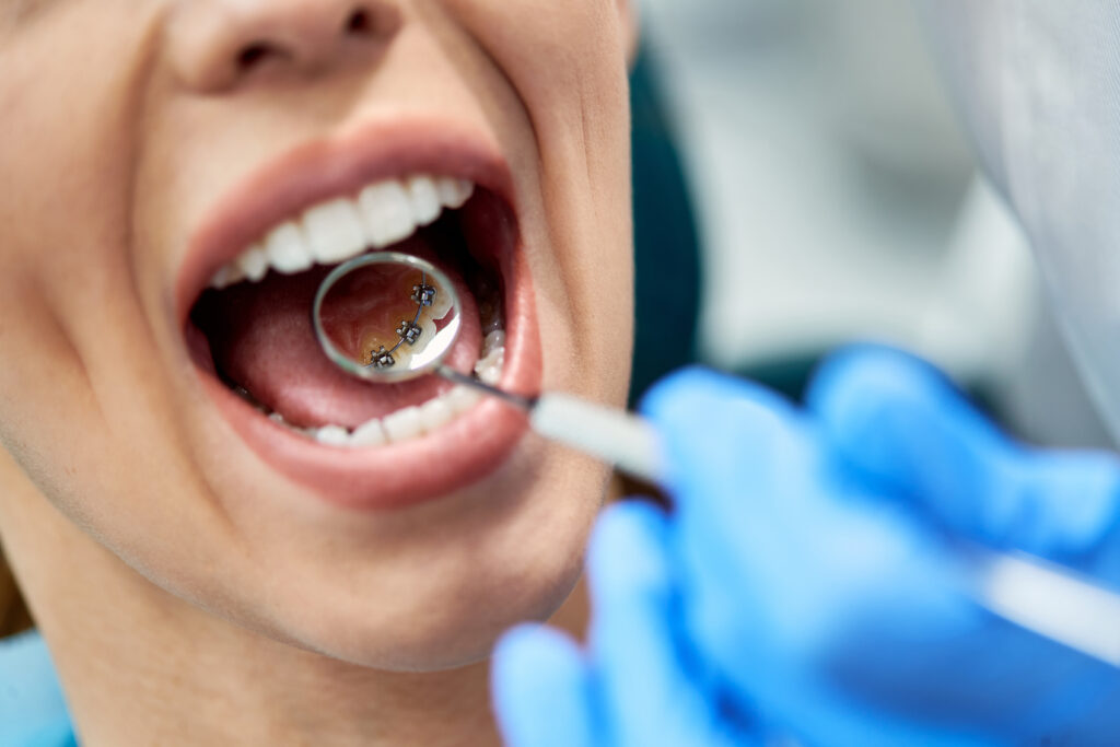Close0up of woman having inner dental braces check-up at dentist's office.
